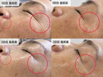 ウィ アネラ(U'i Anela)/WiQo 水光 ピール