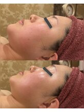 ヴィクトワール シュエット/【フェイシャル】30代1回の変化