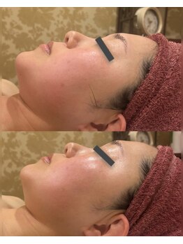 ヴィクトワール シュエット/【フェイシャル】30代1回の変化