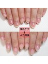 【深爪矯正】クリア４ヶ月後