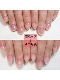 【深爪矯正】クリア４ヶ月後