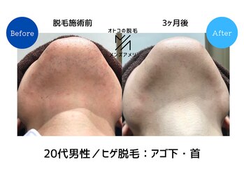 メンズアメリ/高知/メンズ脱毛/ヒゲ/全身/VIO