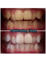 ホワイトニングショップ 阪急伊丹店/ビフォーアフター