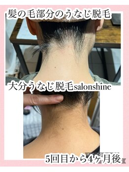 サロンシャイン(Salon Shine)/うなじ脱毛ショートやボブ