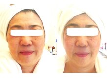 サロンドエステケイワイ(de KY)/小顔・タルミ改善