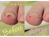 期間限定モニター【巻き爪補正!繰り返さない!】改善 12,800円→5,000円