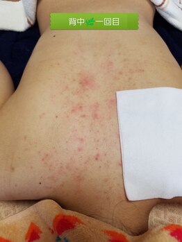 プラーベートサロン エクラ(eclat)/背中ハーブピーリング