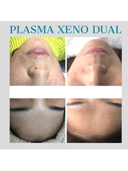 ビーダブリュー(BW...)/☆プラズマゼノデュアル施術例☆