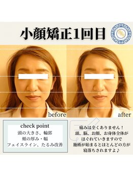 RKY/小顔矯正&頭蓋骨矯正1回(20代)