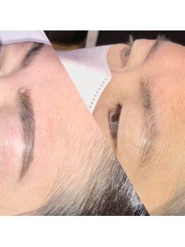 ヴィプラス(Vi+)/