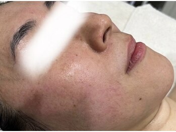 ビューティーサロン アンド ユー シブヤ(Beauty Salon&U Shibuya)/クリスティーナ施術前