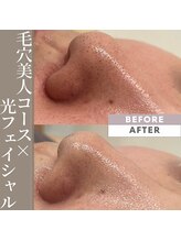 ムー(mu)/鼻の黒ずみ撃退！！