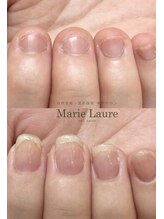 マリーロール 天王寺店(Marie Laure)/自爪育成/深爪矯正/ネイルケア
