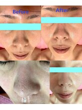 脱毛 フェイシャルサロン 光/リピーター様続出超音波毛穴洗浄