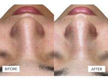 エングラッシー(en glassy)/BEFORE　AFTER　10代