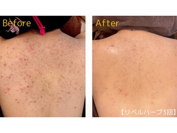 ロイヤリティ(ROYALTY)/背中のニキビケア