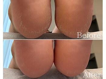 カシェット 広島店(Cachette)/20代女性☆足裏角質ケア90分