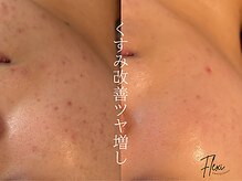 フレキシ 表参道(Flexi)の雰囲気（繰り返す肌荒れはピーリングと皮膚細胞の強化で解決◎）