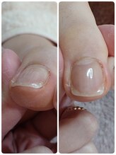 フットスタジオ アルク(FOOT STUDIO ALUK)/【オルソフラット】巻き爪予防