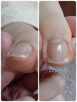 フットスタジオ アルク(FOOT STUDIO ALUK)/【オルソフラット】巻き爪予防