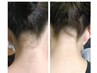 うなじ、襟足は見られています！自信を持ってアップヘアへ今こそ脱毛がお得！