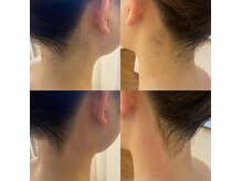 レコルト デ ベルシア BELCIA福岡店(recolte de BELCIA)/うなじワックス脱毛♪