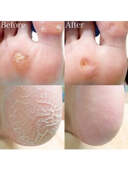 巻き爪補正店 北千住店/施術【足裏トータルケア】