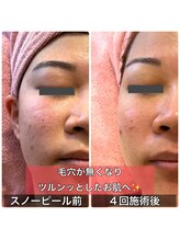 サロンデイジー(Salon Daisy)/ホワイトスノーピール★施術一回