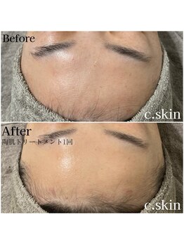 シースキン 盛岡駅前店(c.skin)/お客様ビフォーアフター