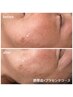 【新コース★美白・乾燥ケア】お悩みオーダーメイド導入+ビタA導入+速攻小顔