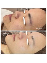 ラディエンス 多治見店/リアボーテ毛穴ケアエステ