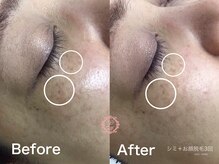 ラウレア(LAULEA)/シミケアBefore/after(3ヶ月)
