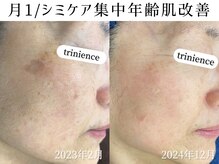 シミケアと年齢肌を同時にケア！コンディション爆上がり☆