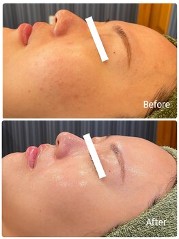 エクセレントビューティーサロン 艶(EN)/肌荒れ・ニキビ・くすみ・赤み