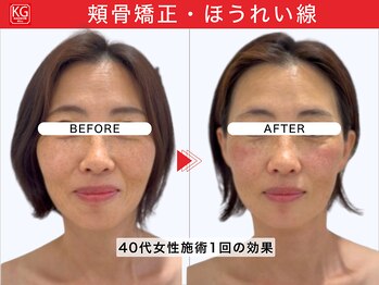 顔ジム 麻布店/40代女性顔ジム1回の効果