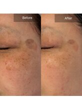 マインエム(mine.m)/シミ/くすみ/たるみ