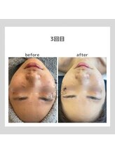 韓国肌管理室pom.haneul【ポムハヌル】LDM/インモード/ララピール/プラピール福岡天神/韓国肌管理室