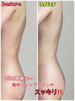ルミネ(Lumine)/気になる背中・ヒップラインに！