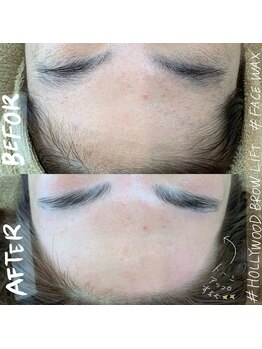 ザ ベッピン(the 別嬪)/丸いおでこを作るにはWAX脱毛