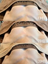 タオ(TAO)/バストアップ症例