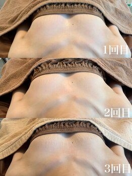 タオ(TAO)/バストアップ症例