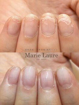 マリーロール 淀屋橋本店(Marie Laure)/自爪育成/深爪矯正/ネイルケア