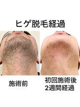 フルール(fleur)/ヒゲ脱毛