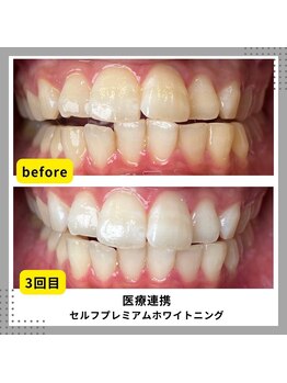 エクラブロウ(ECLAT BROW)/医療提携ホワイトニング