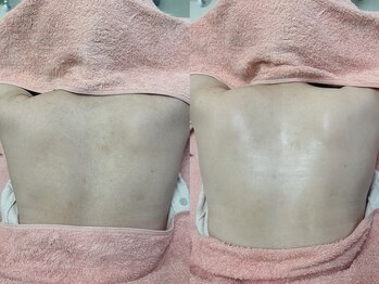 ソルシエール キレイ(ソルシエールkirei)/うるつやお背中シェービング