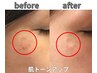 長年お肌のシミにお悩みの方【6種類の高濃度ビタミンC導入】でシミを改善！