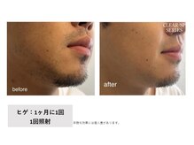 リネ(Rine)/【before→after】