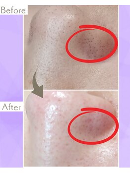 サロン モウ(mou。)/何をしてもダメだった毛穴黒ずみ