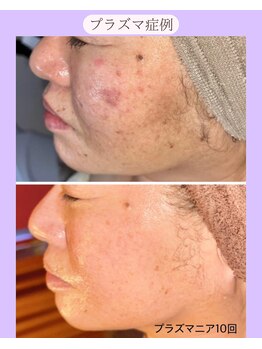 ホリホック/プラズマ症例