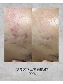 コンクパール(CONCH PEARL.)/プラズマニア